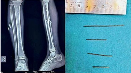 *टायर फटने से बच्चे के पैरों में धंसे लोहे के 4 टुकड़े*