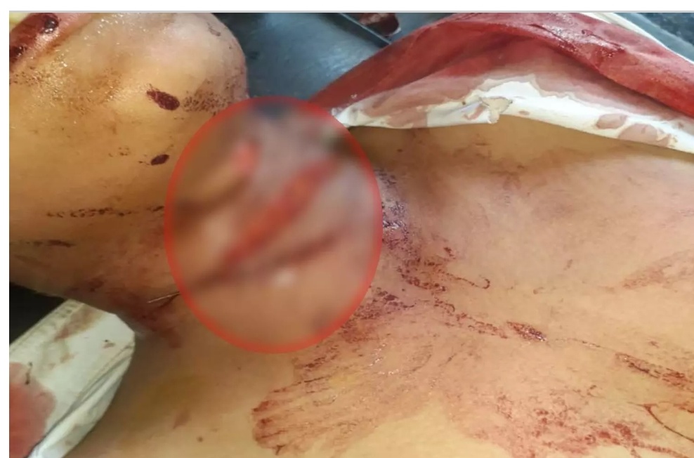 *6 वी कक्षा के मासूम बच्चे पर चाकू से हमला*