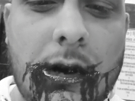 *रायपुर में चाइनीज मांझे से एक छात्र के गाल कटे, 34 टांके लगे*